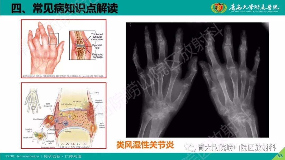 影像PPT - 【PPT】骨关节影像诊断培训要点解析-53
