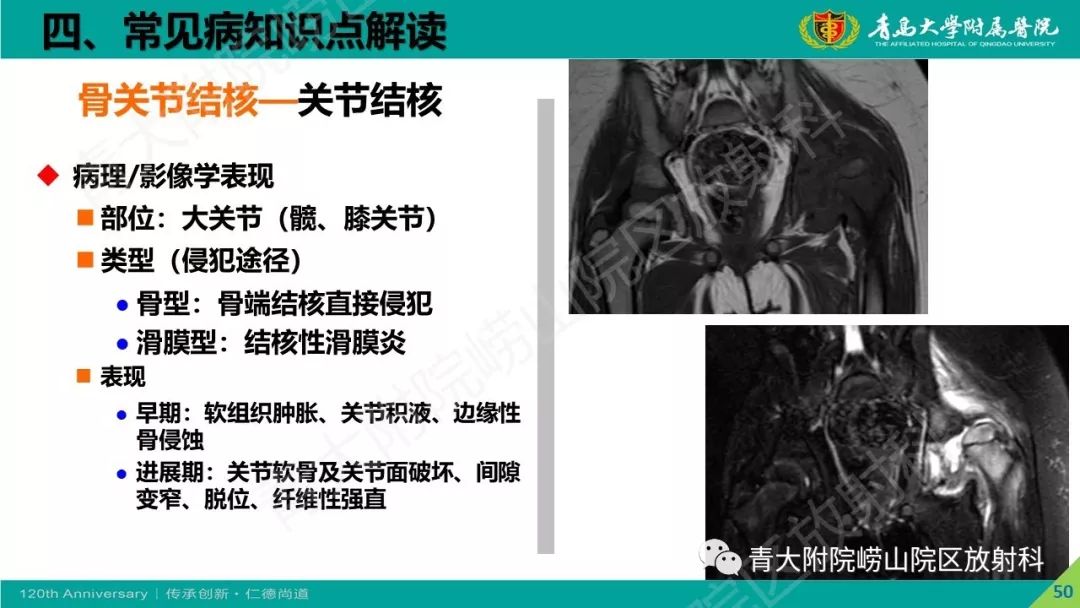 影像PPT - 【PPT】骨关节影像诊断培训要点解析-50