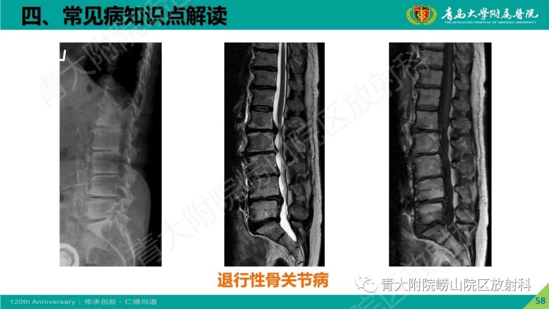影像PPT - 【PPT】骨关节影像诊断培训要点解析-58