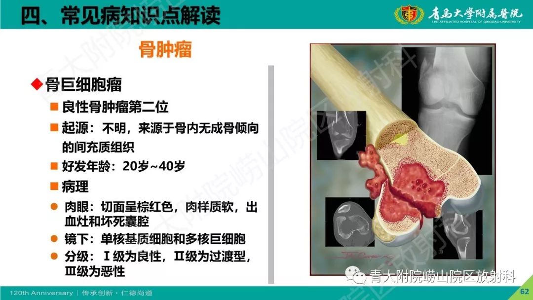 影像PPT - 【PPT】骨关节影像诊断培训要点解析-62