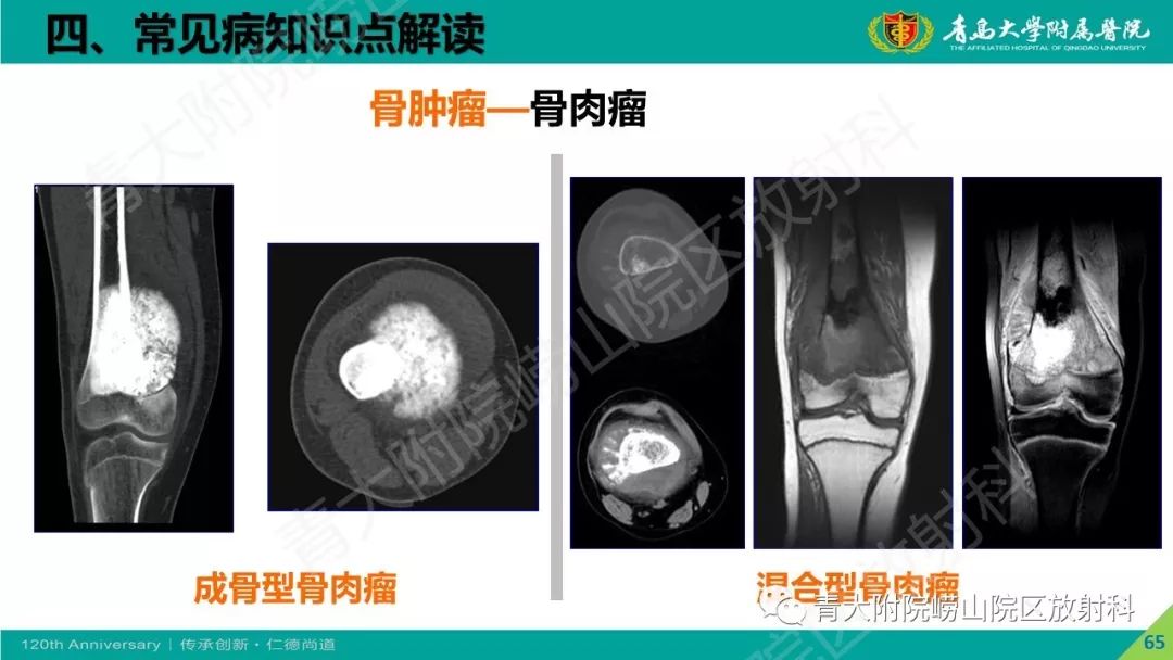 影像PPT - 【PPT】骨关节影像诊断培训要点解析-65