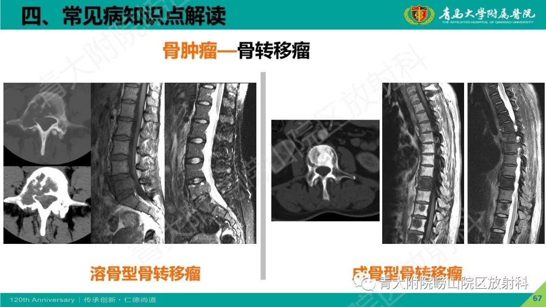 影像PPT - 【PPT】骨关节影像诊断培训要点解析-67