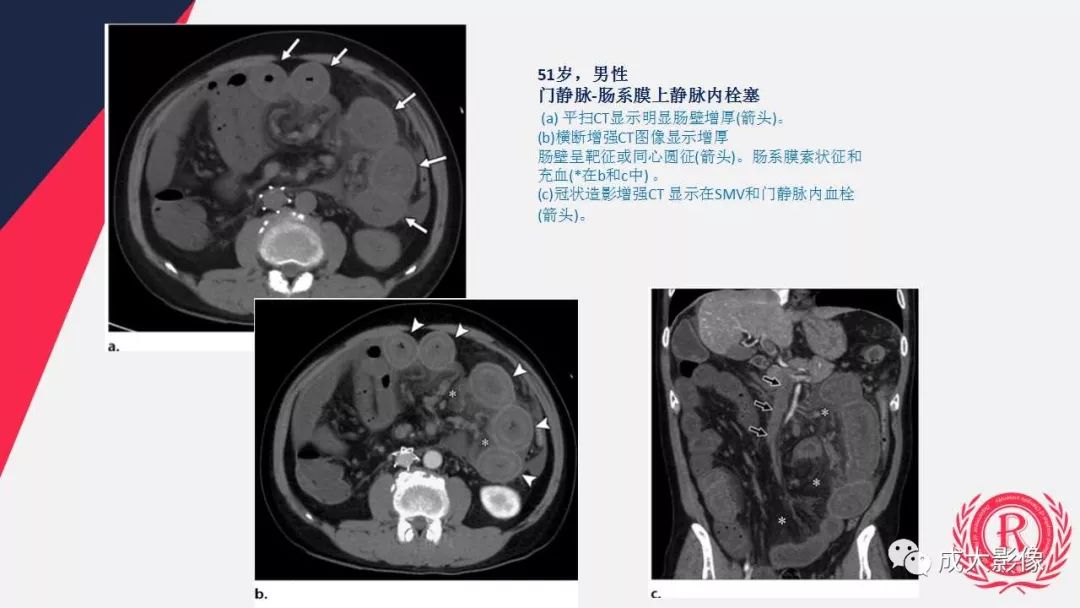 影像PPT - 【PPT】多层螺旋CT诊断急性肠系膜缺血-11