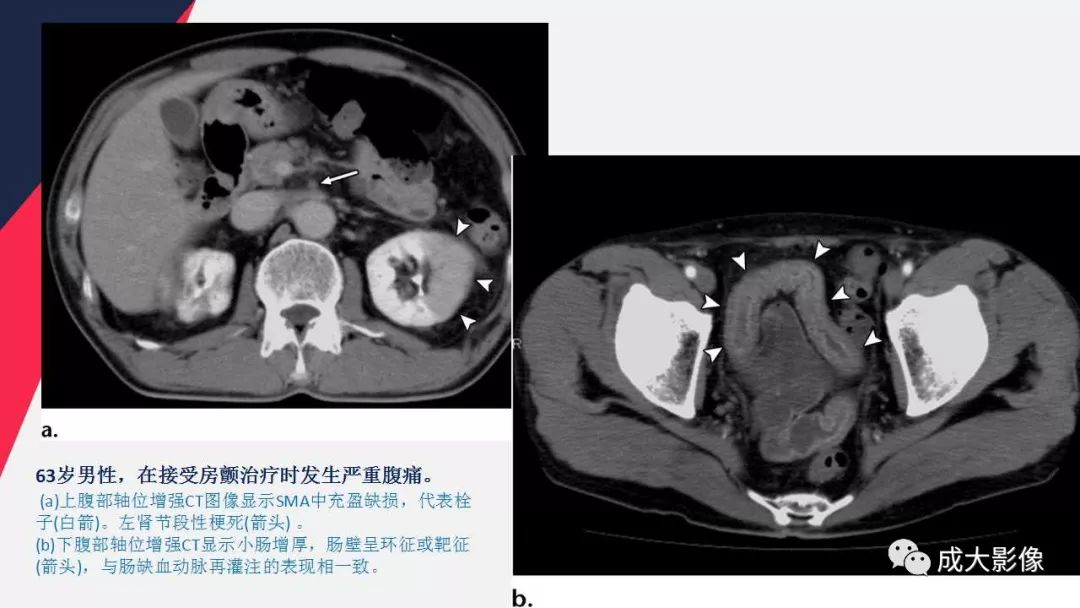 影像PPT - 【PPT】多层螺旋CT诊断急性肠系膜缺血-13
