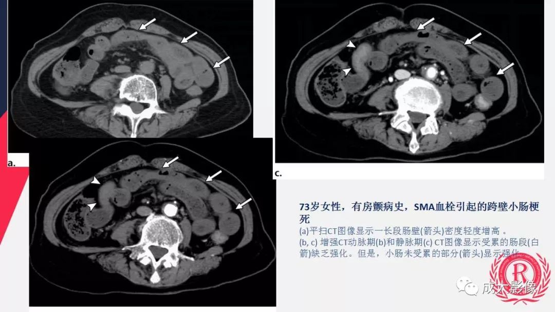 影像PPT - 【PPT】多层螺旋CT诊断急性肠系膜缺血-16