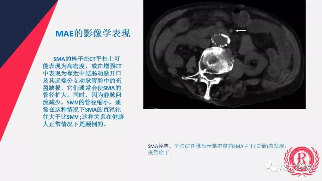 影像PPT - 【PPT】多层螺旋CT诊断急性肠系膜缺血-23