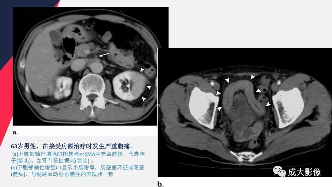 影像PPT - 【PPT】多层螺旋CT诊断急性肠系膜缺血-24