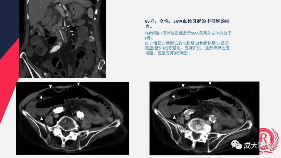 影像PPT - 【PPT】多层螺旋CT诊断急性肠系膜缺血-27