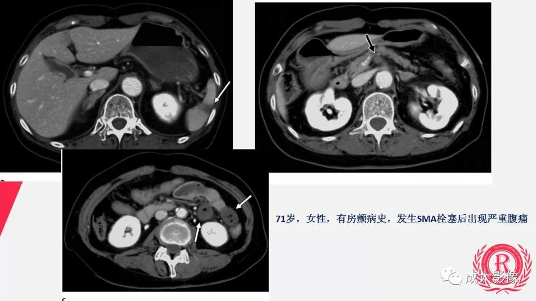 影像PPT - 【PPT】多层螺旋CT诊断急性肠系膜缺血-35