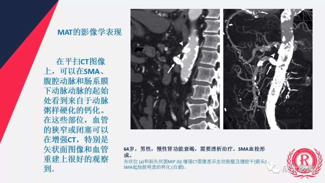 影像PPT - 【PPT】多层螺旋CT诊断急性肠系膜缺血-39