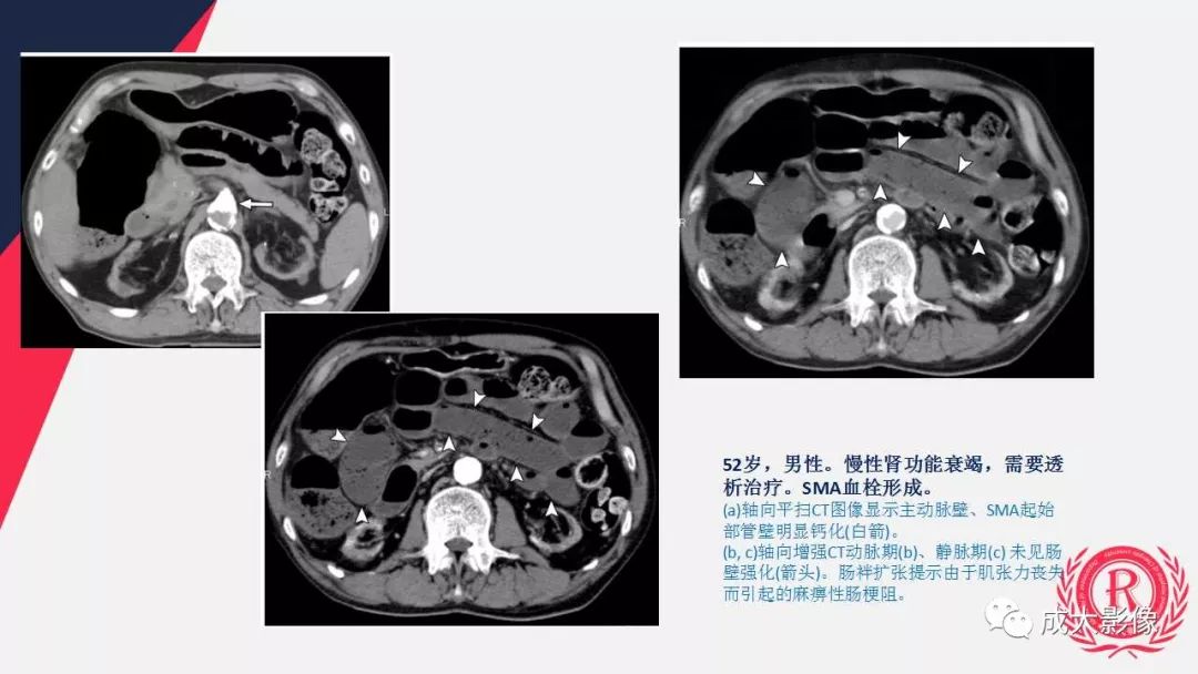 影像PPT - 【PPT】多层螺旋CT诊断急性肠系膜缺血-40