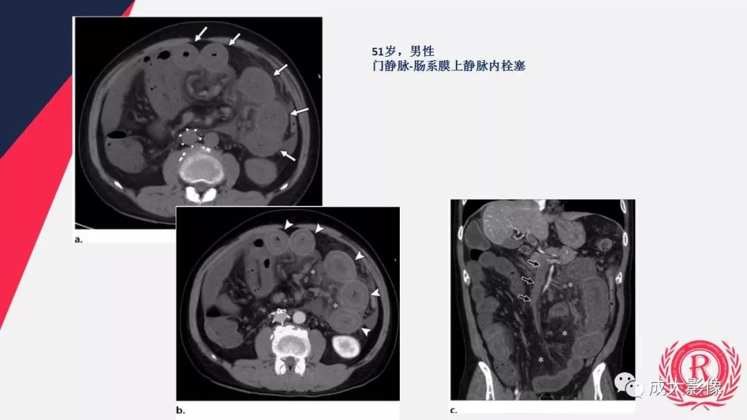 影像PPT - 【PPT】多层螺旋CT诊断急性肠系膜缺血-45