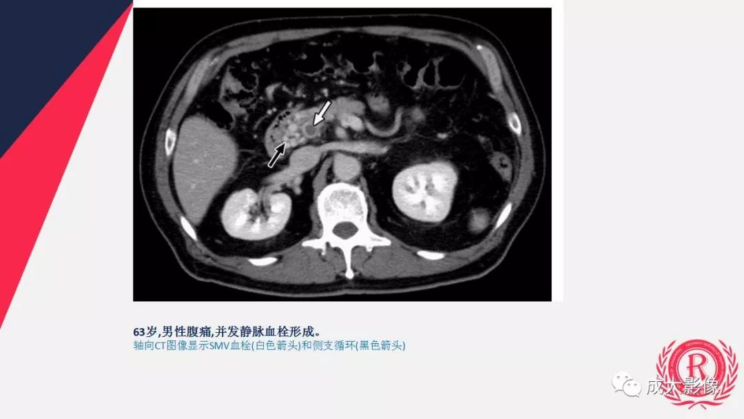 影像PPT - 【PPT】多层螺旋CT诊断急性肠系膜缺血-46
