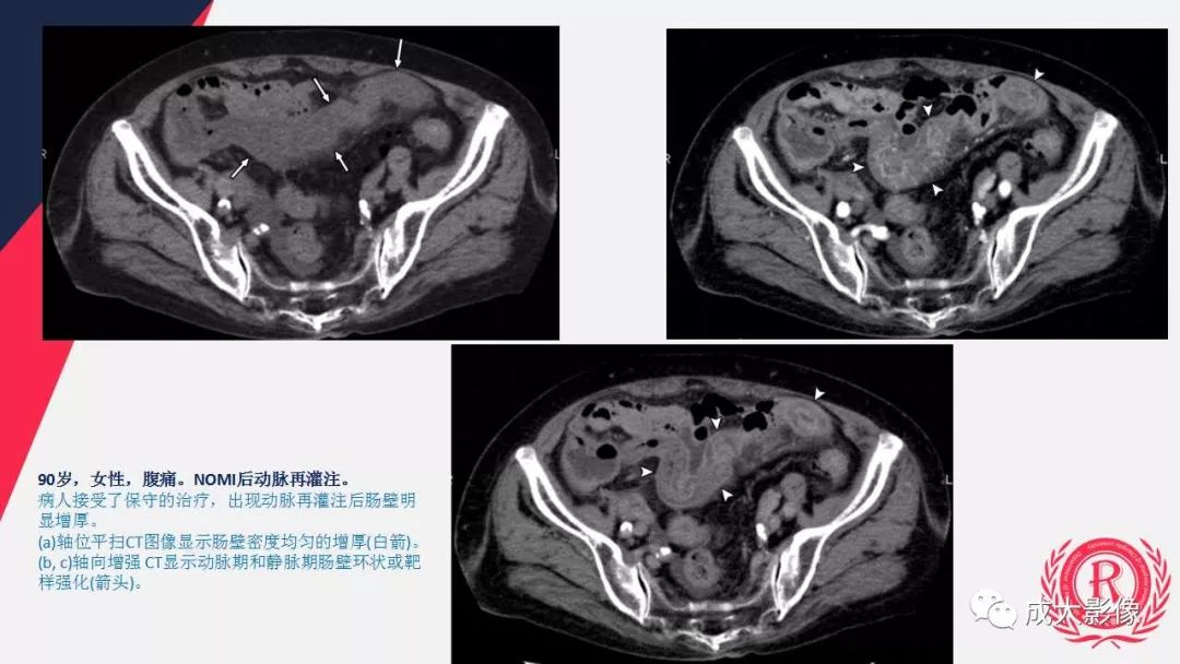 影像PPT - 【PPT】多层螺旋CT诊断急性肠系膜缺血-52