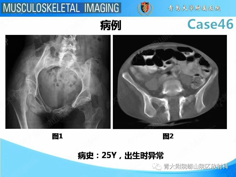影像PPT - 【PPT】尾部退化综合征-2