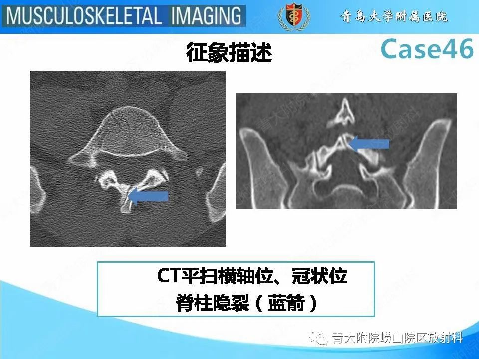 影像PPT - 【PPT】尾部退化综合征-6