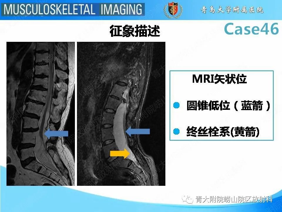 影像PPT - 【PPT】尾部退化综合征-9