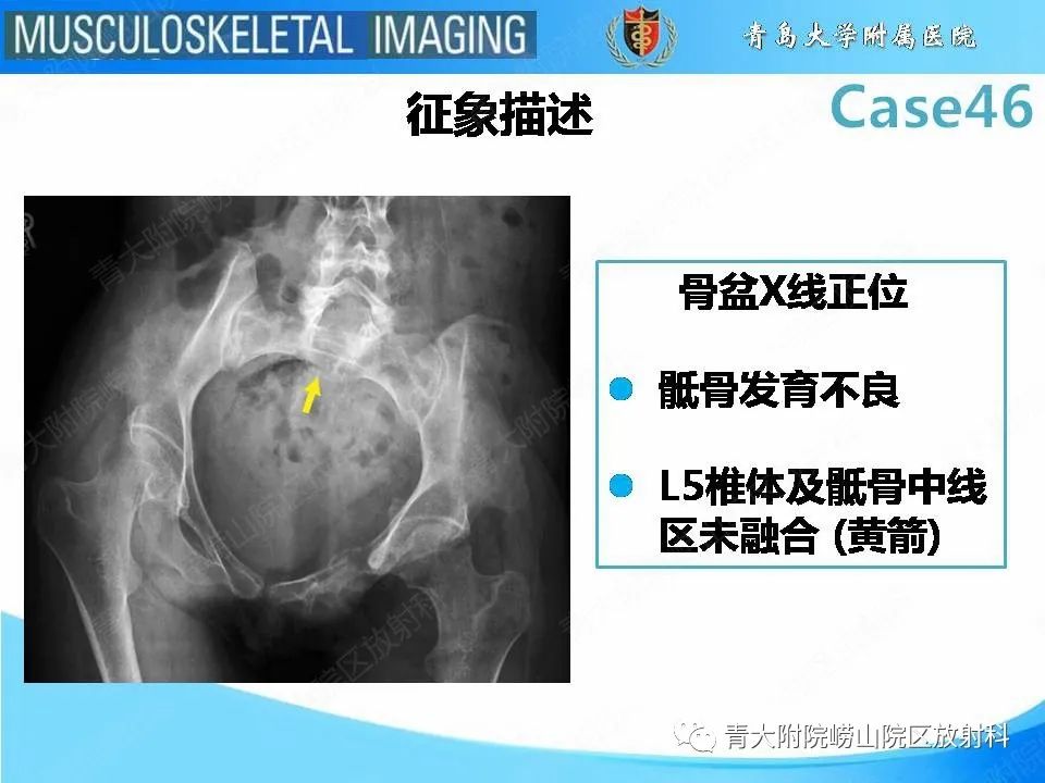 影像PPT - 【PPT】尾部退化综合征-16
