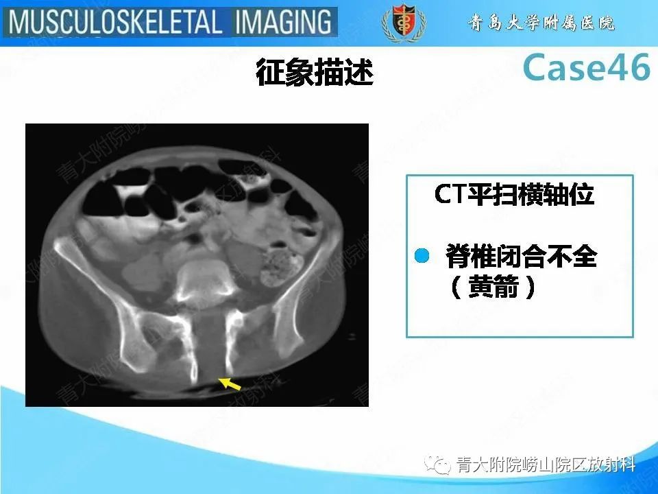 影像PPT - 【PPT】尾部退化综合征-17