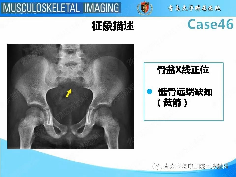影像PPT - 【PPT】尾部退化综合征-18
