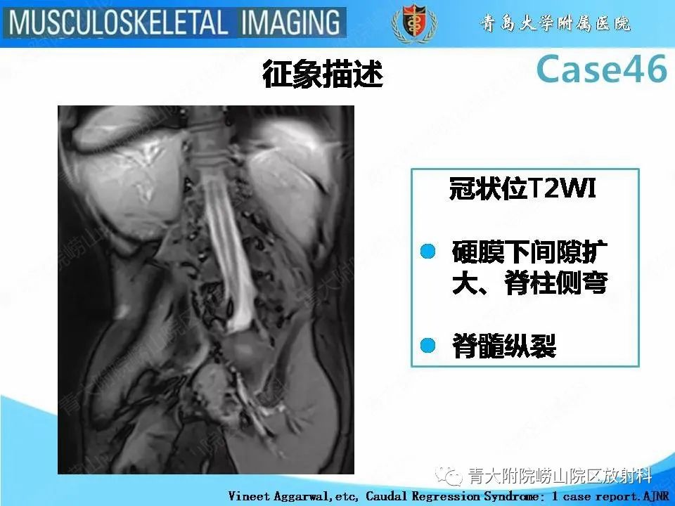 影像PPT - 【PPT】尾部退化综合征-19