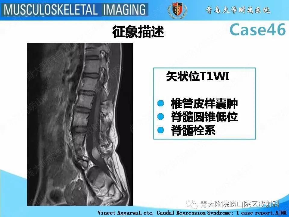 影像PPT - 【PPT】尾部退化综合征-20