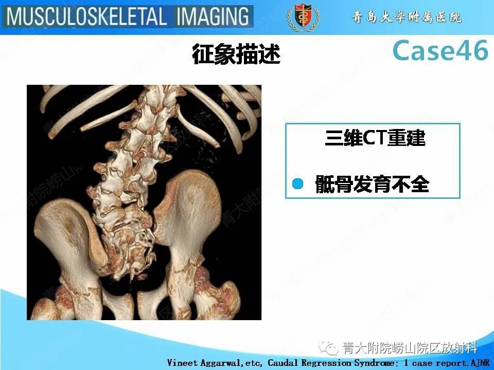 影像PPT - 【PPT】尾部退化综合征-21