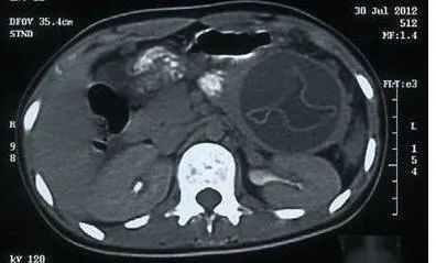 影像PPT - 胰腺真性囊肿分类及诊断-3 影像PPT - 胰腺真性囊肿分类及诊断-3