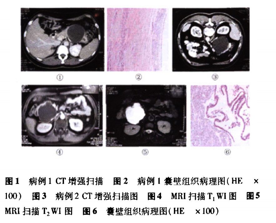 影像PPT - 胰腺真性囊肿分类及诊断-2 影像PPT - 胰腺真性囊肿分类及诊断-2