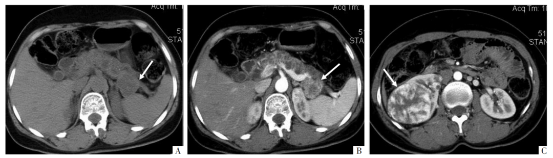 影像PPT - 胰腺真性囊肿分类及诊断-5 影像PPT - 胰腺真性囊肿分类及诊断-5