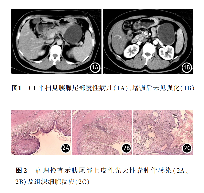 影像PPT - 胰腺真性囊肿分类及诊断-1 影像PPT - 胰腺真性囊肿分类及诊断-1