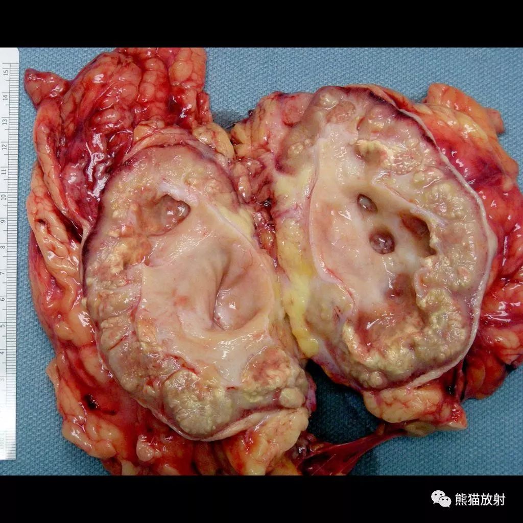 影像PPT - “熊掌征”,这个征象提示个啥?-14 影像PPT - “熊掌征”,这个征象提示个啥?-14