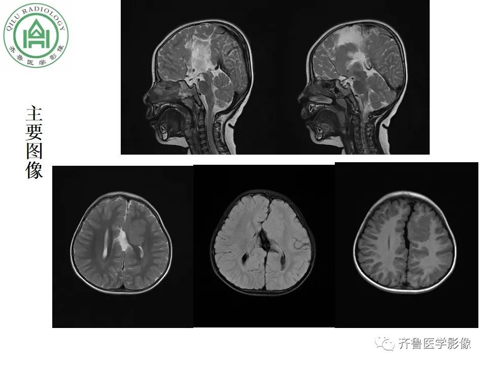 影像PPT - 【病例】胼胝体发育不良2例影像诊断-3