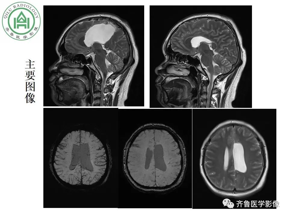 影像PPT - 【病例】胼胝体发育不良2例影像诊断-6