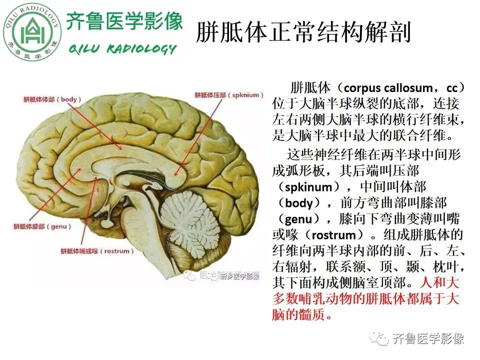 影像PPT - 【病例】胼胝体发育不良2例影像诊断-8