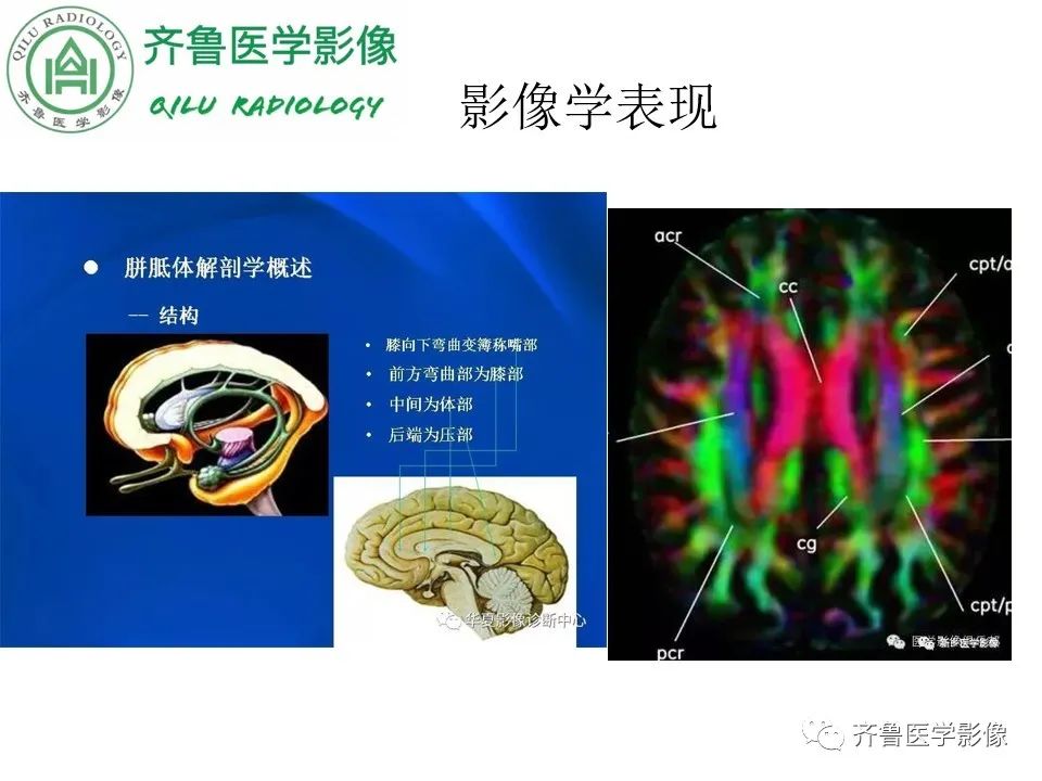 影像PPT - 【病例】胼胝体发育不良2例影像诊断-9