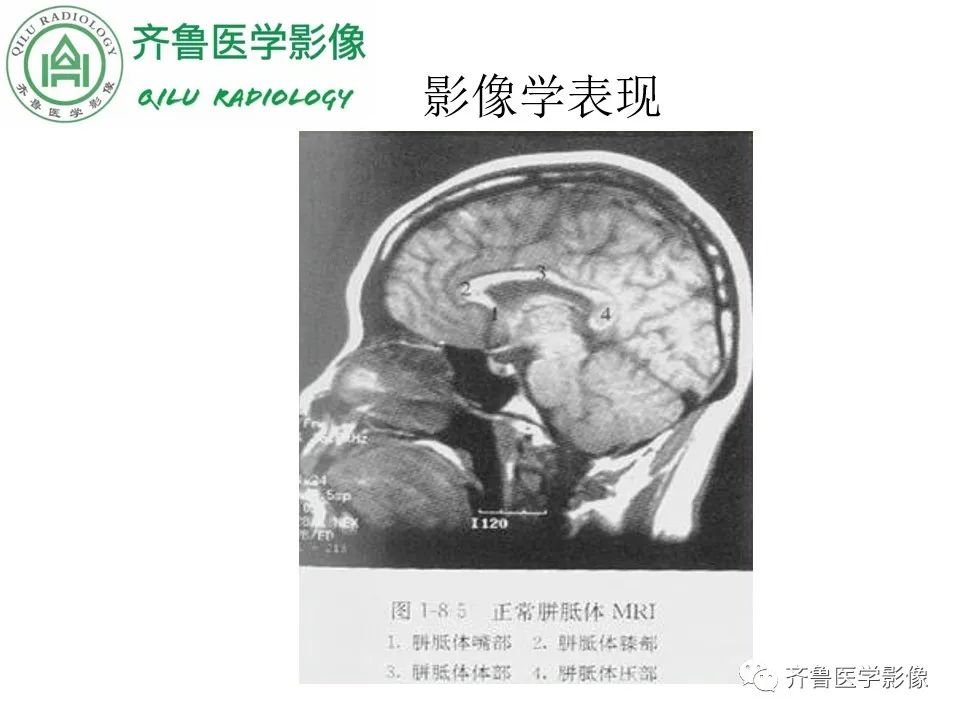 影像PPT - 【病例】胼胝体发育不良2例影像诊断-10