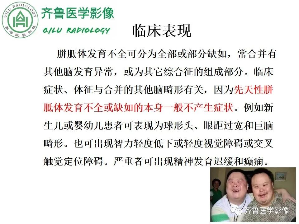 影像PPT - 【病例】胼胝体发育不良2例影像诊断-14