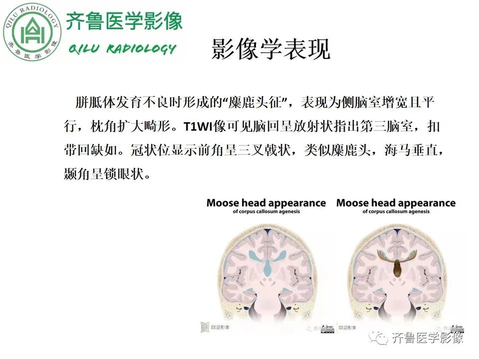 影像PPT - 【病例】胼胝体发育不良2例影像诊断-18