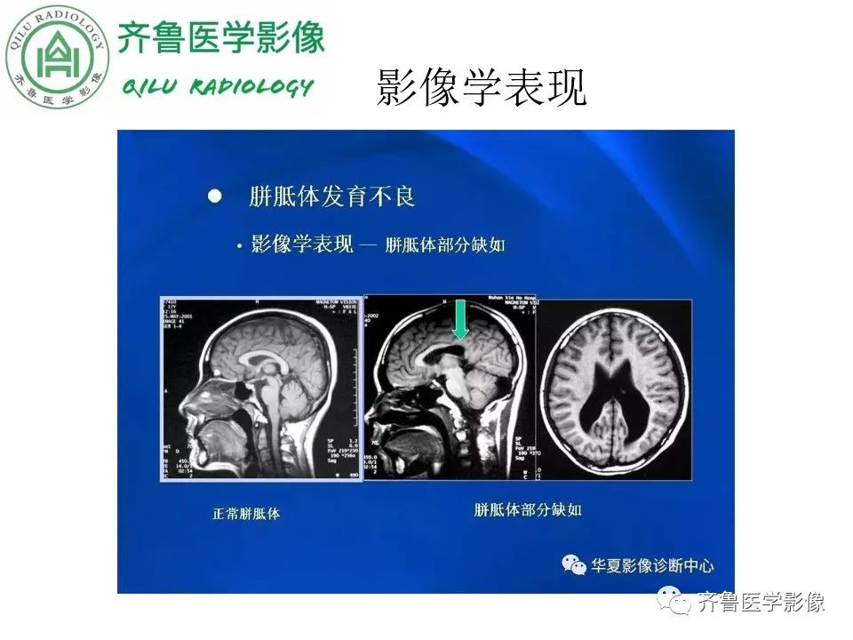 影像PPT - 【病例】胼胝体发育不良2例影像诊断-17