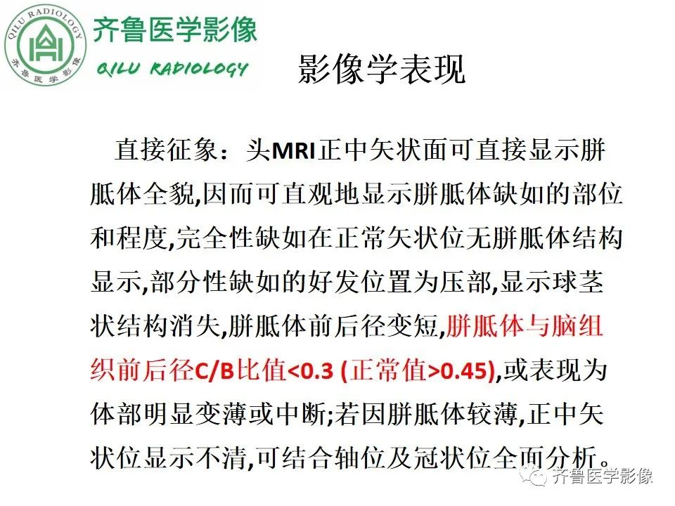 影像PPT - 【病例】胼胝体发育不良2例影像诊断-15