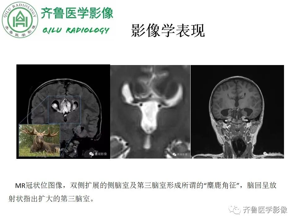 影像PPT - 【病例】胼胝体发育不良2例影像诊断-19