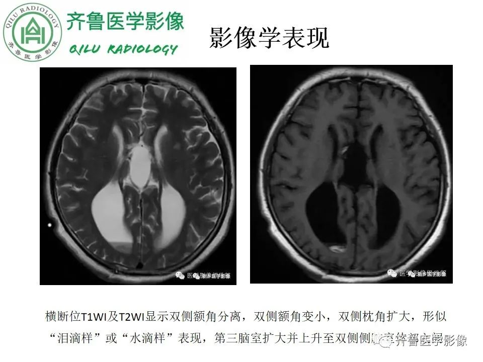 影像PPT - 【病例】胼胝体发育不良2例影像诊断-20