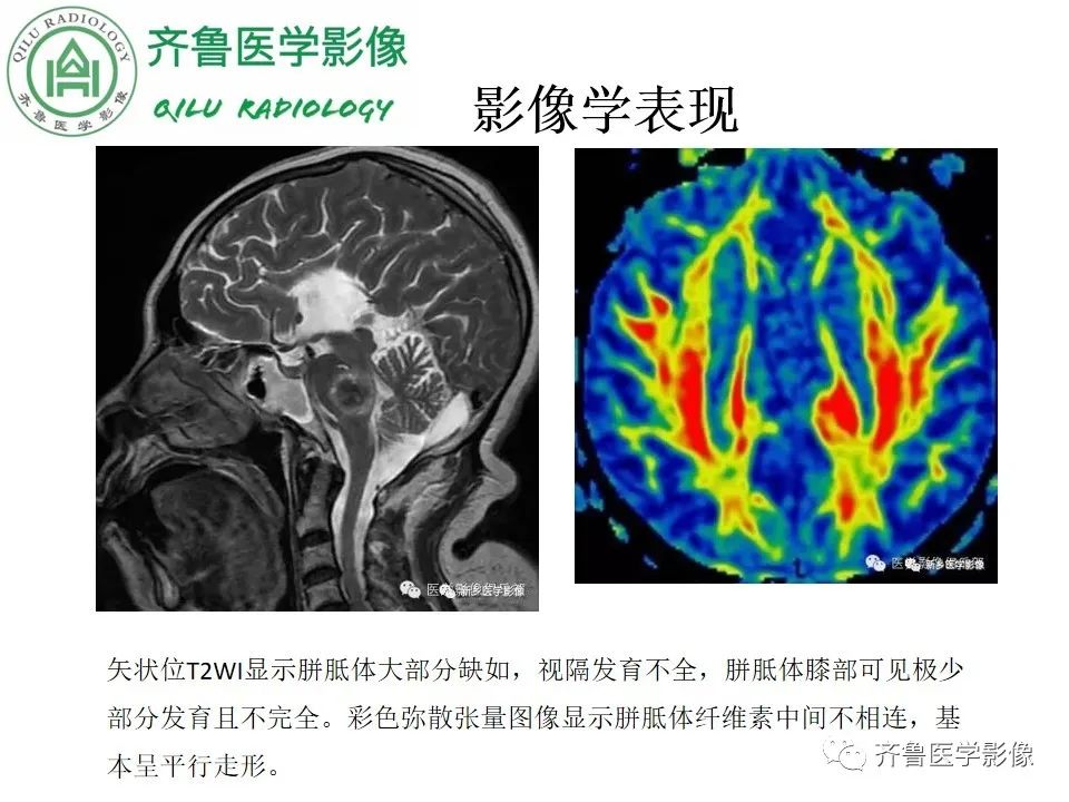 影像PPT - 【病例】胼胝体发育不良2例影像诊断-21
