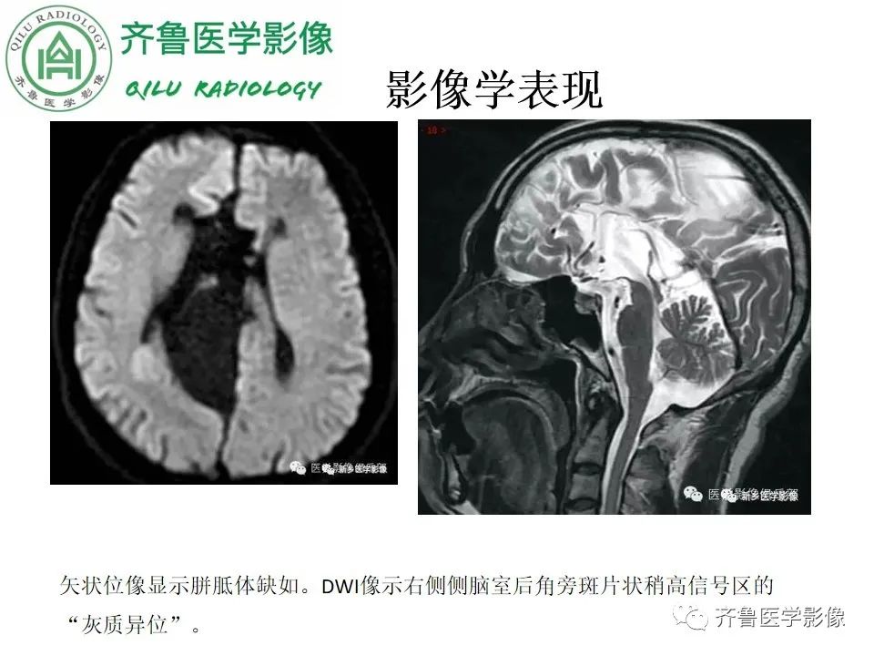 影像PPT - 【病例】胼胝体发育不良2例影像诊断-23