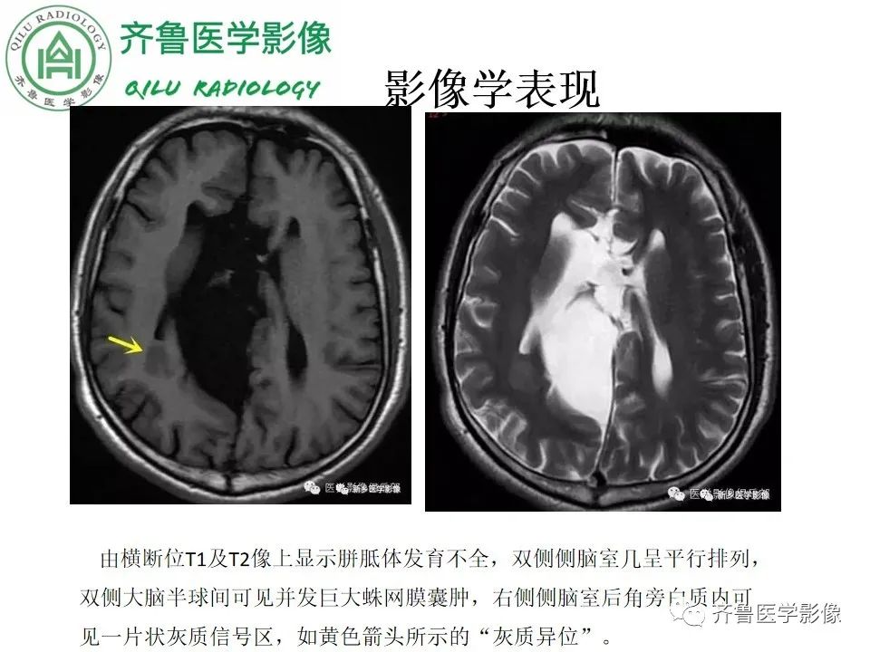 影像PPT - 【病例】胼胝体发育不良2例影像诊断-22