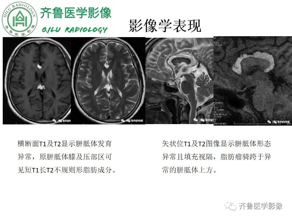 影像PPT - 【病例】胼胝体发育不良2例影像诊断-24