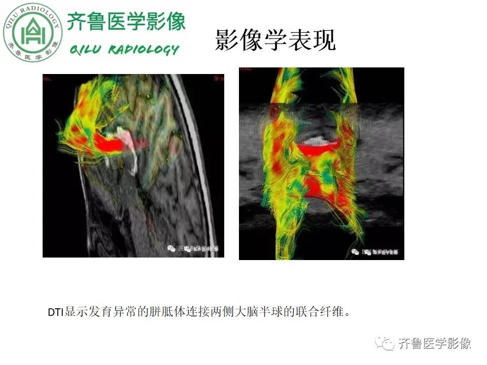 影像PPT - 【病例】胼胝体发育不良2例影像诊断-25