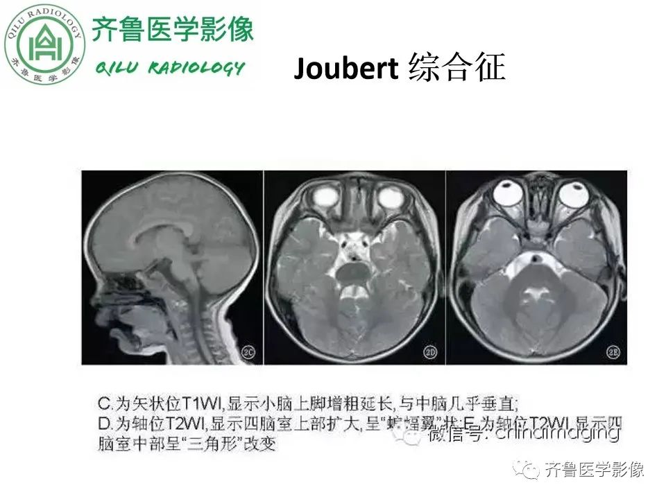 影像PPT - 【病例】胼胝体发育不良2例影像诊断-32