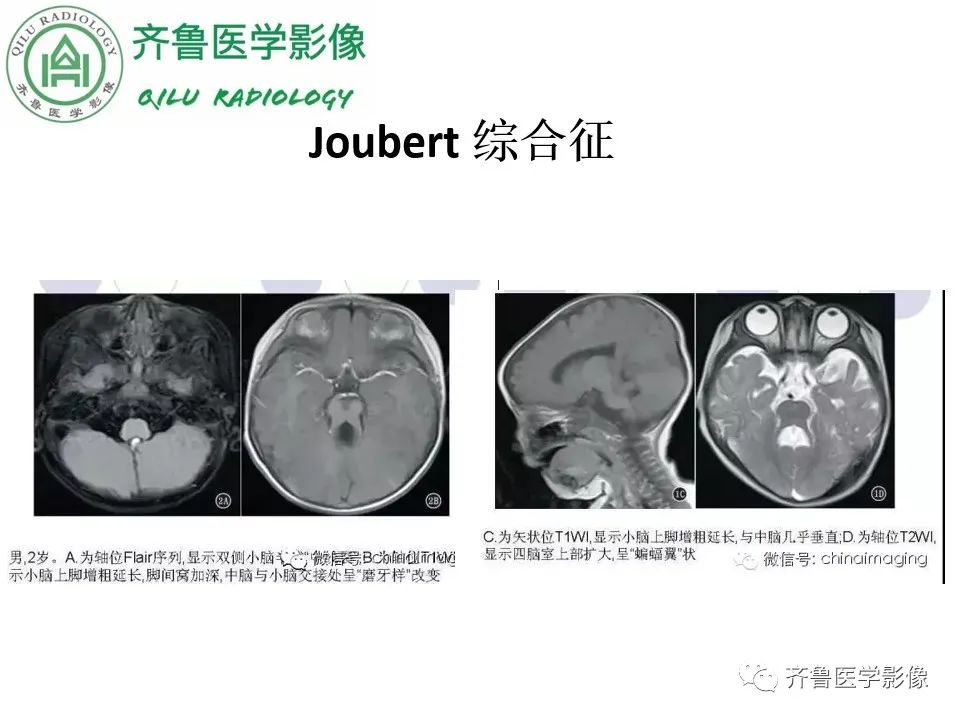 影像PPT - 【病例】胼胝体发育不良2例影像诊断-30
